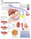 Understanding Diabetes Laminated Poster