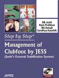 Management of Clubfoot by Jess