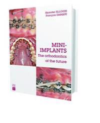 Mini-Implants