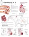Understanding ACS (Acute Coronary Syndrome) Laminated Poster