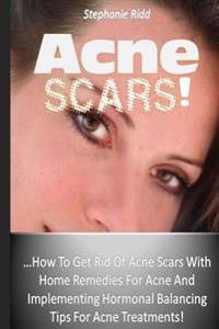Acne Scars!: How to Get Rid of Acne Scars with Home Remedies for Acne and Implementing Hormonal Balancing Tips for Acne Treatments!
