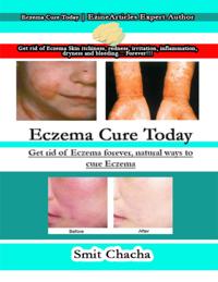 Eczema Cure Today: Get Rid of Eczema Forever, Natural Ways to Cure Eczema