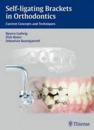Self-Ligating Brackets in Orthodontics