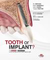 Tooth or Implant