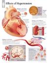 Effects of Hypertension Paper Poster